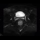 Chronic inflammatory changes of terminal ileum and rectum, pelvic lipomatosis: MRI - Magnetic Resonance Imaging